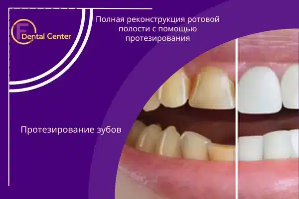 Полная реконструкция ротовой полости с помощью протезирования