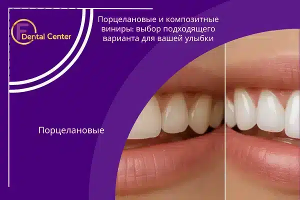 Порцелановые и композитные виниры