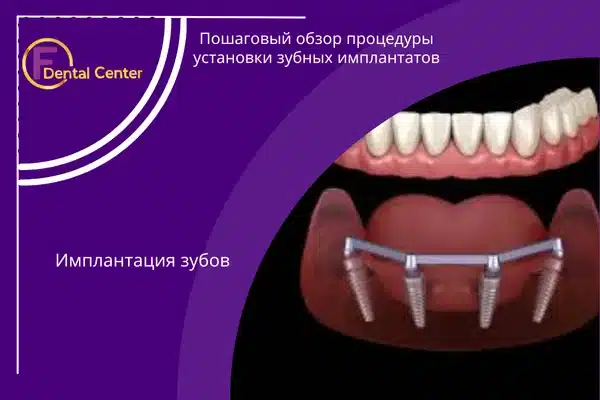 Пошаговый обзор процедуры установки зубных имплантатов