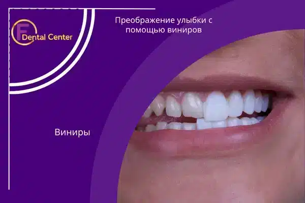 Преображение улыбки с помощью виниров