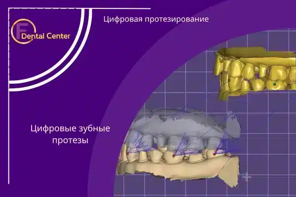 Цифровая протезирование