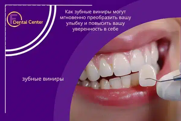 зубные виниры