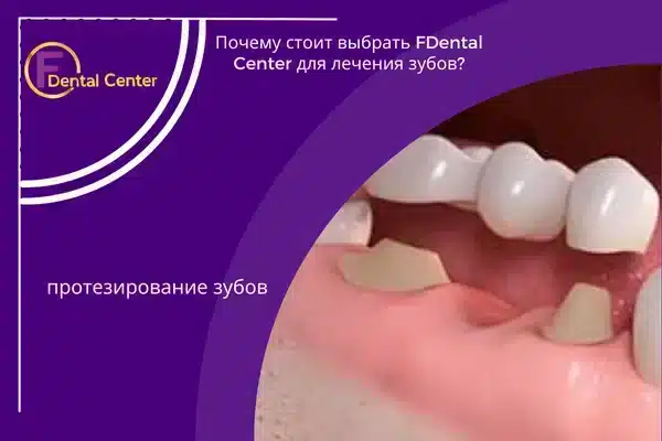 Почему стоит выбрать FDental Center для лечения зубов?