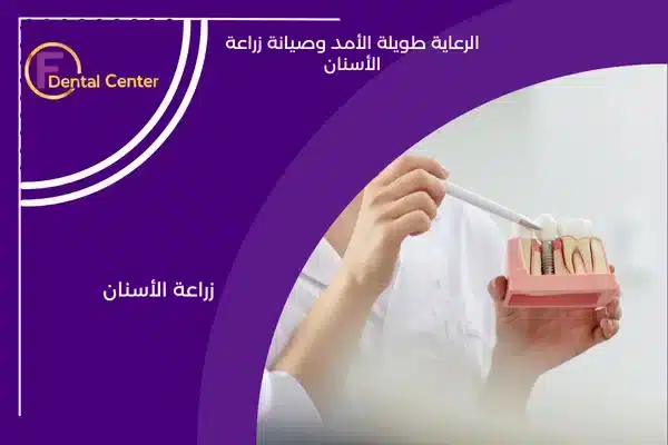 الرعاية طويلة الأمد وصيانة زراعة الأسنان