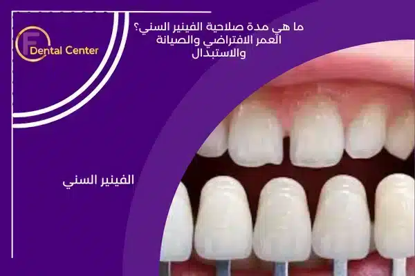 ما هي مدة صلاحية الفينير السني؟ العمر الافتراضي والصيانة والاستبدال