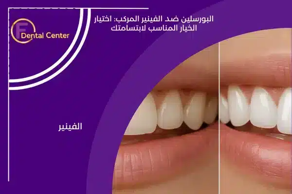 البورسلين ضد الفينير المركب: اختيار الخيار المناسب لابتسامتك