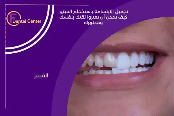 تجميل الابتسامة باستخدام الفينير: كيف يمكن أن يغيروا ثقتك بنفسك ومظهرك