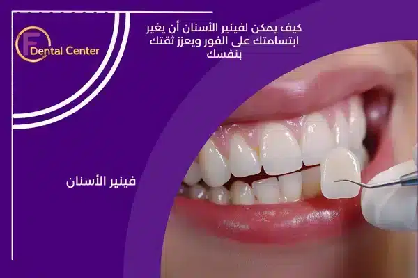 كيف يمكن لفينير الأسنان أن يغير ابتسامتك على الفور ويعزز ثقتك بنفسك